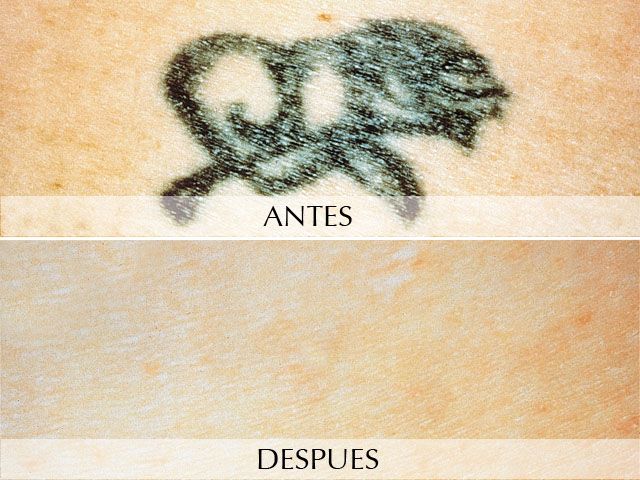 Antes y Después Taques cutànies - Làser