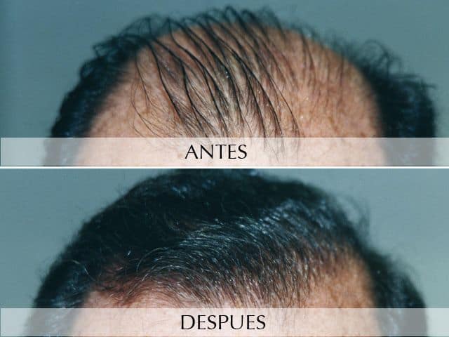 Antes y Después Hair micro-grafts