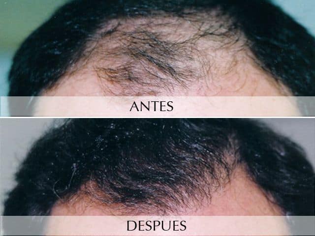 Antes y Después Microempelts Capil.lars