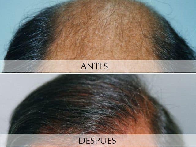 Antes y Después Microempelts Capil.lars