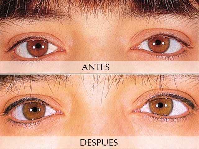 Antes y Después Micropigmentation