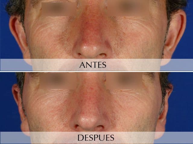 Antes y Después Cirurgia de les Orelles