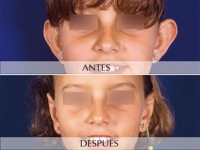 Antes y Después Prominent Ears