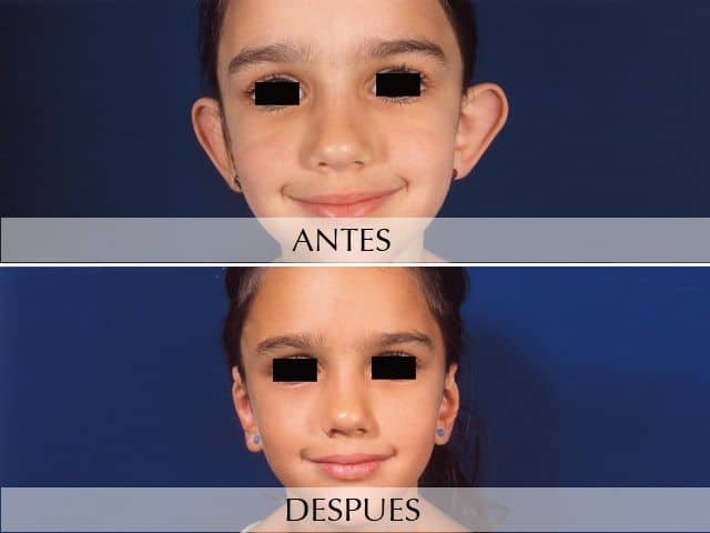 Antes y Después Cirurgia de les Orelles