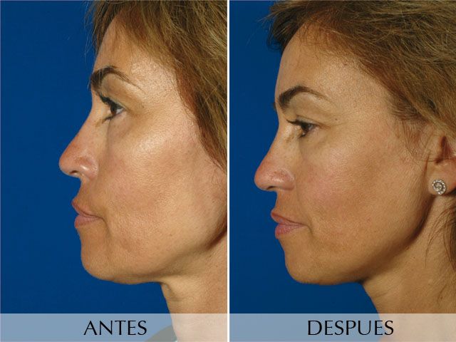 Antes y Después Radiofrecuencia - Thermage CPT