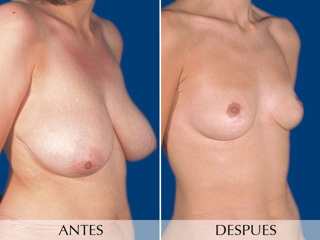 Antes y Después Breast Reduction