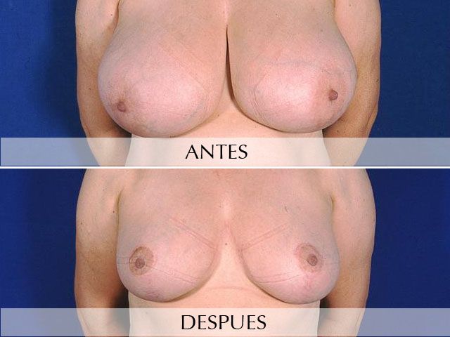 Antes y Después Breast Reduction