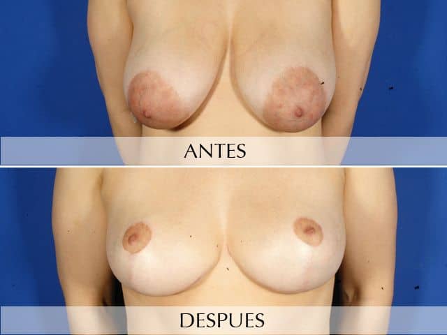 Antes y Después Reducción de pecho