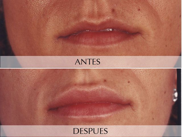 Antes y Después Farciments facials