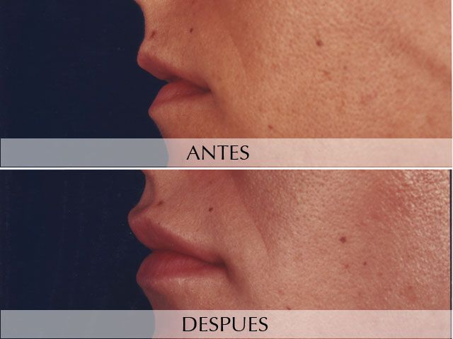 Antes y Después Farciments facials