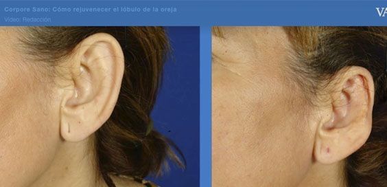 ¿Cómo rejuvenecer el lóbulo de la oreja?