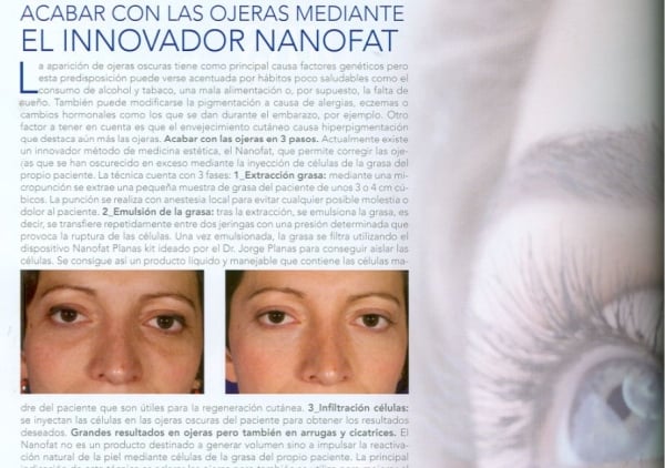 Acabar con las ojeras mediante el innovador Nanofat