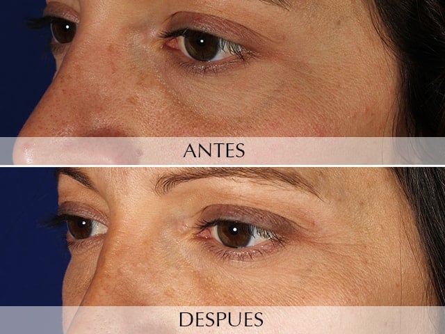 Antes y Después Removal of dark circles