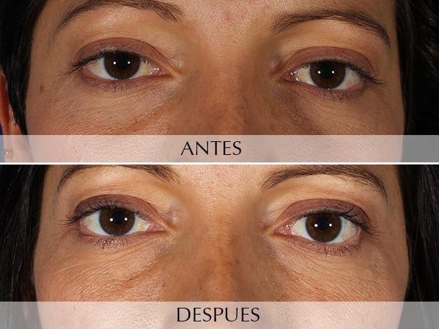 Antes y Después Ojeras oscuras