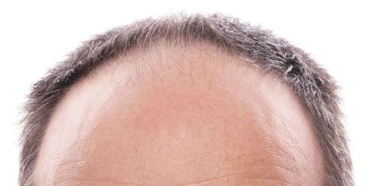 Técnicas para solucionar al alopecia