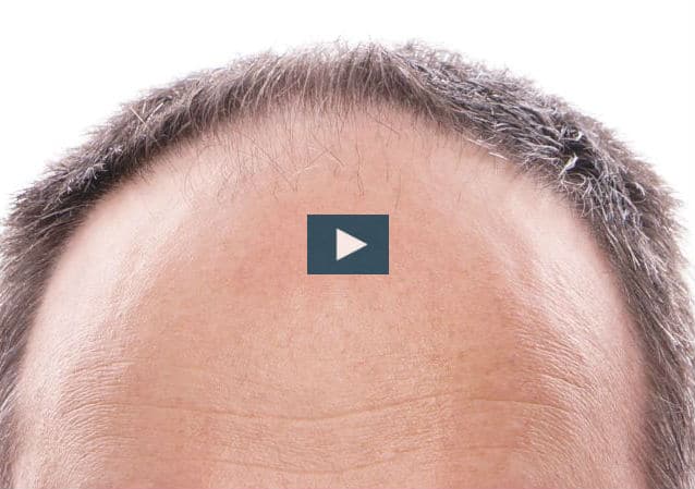 ¿Cómo solucionar la alopecia?