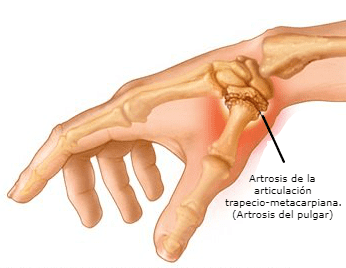 Rizartrosis o artrosis del pulgar. Síntomas, tratamiento y