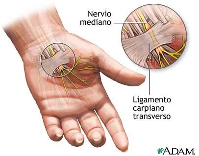 Síndrome del túnel carpiano - Tran Plastic Surgery