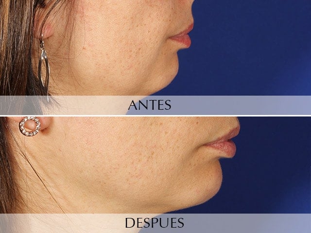 Antes y Después Cirurgia de Mentó