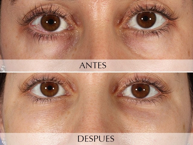 Antes y Después Removal of dark circles