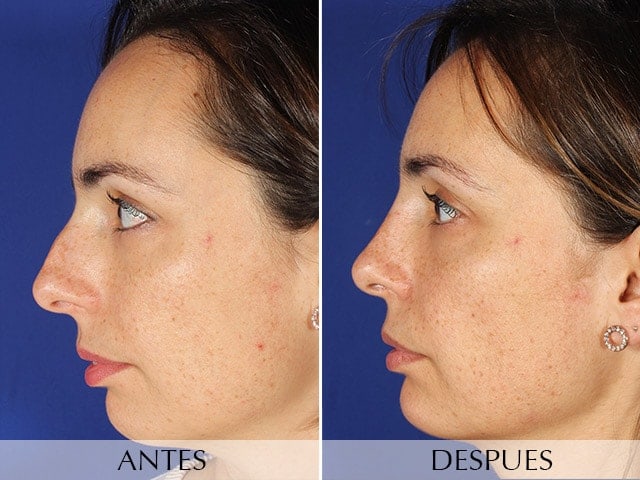 Rinoplastia Clinica Planas Barcelona Madrid