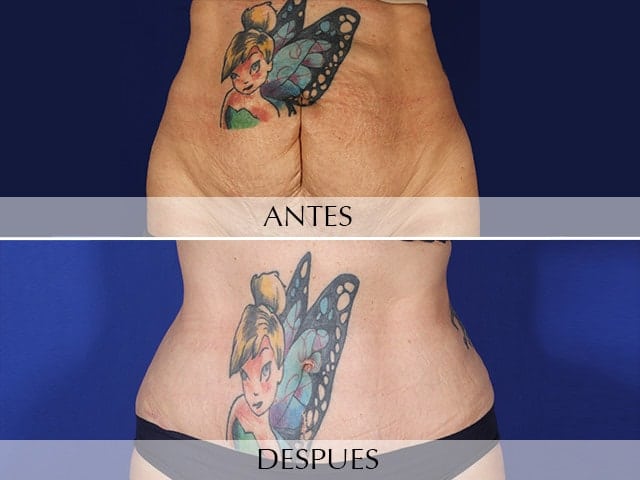 Antes y Después Abdominoplastia