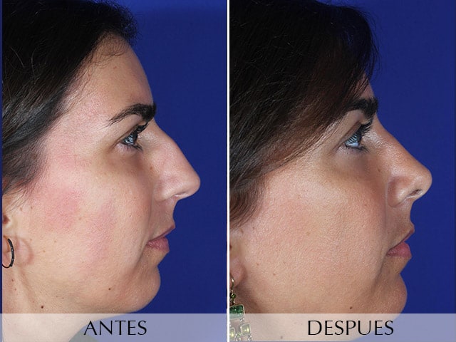 Antes y Después Cirurgia de Mentó