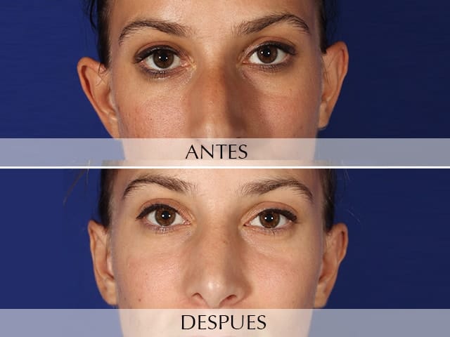 Antes y Después Cirurgia de les Orelles