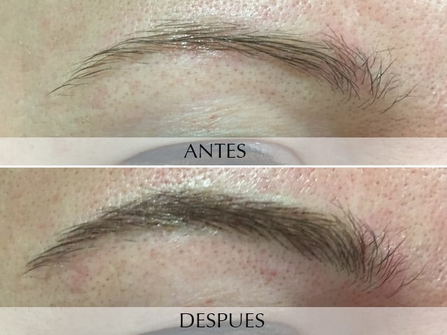 Antes y Después Microinjertos de cejas