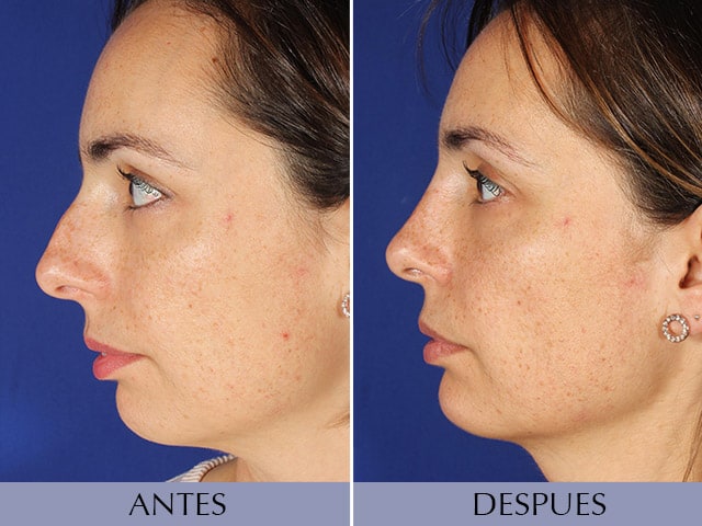 Antes y Después Chin Surgery