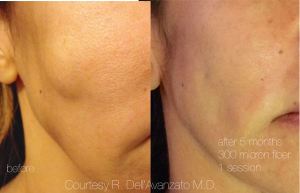 Antes y Después Eufoton 800 laser