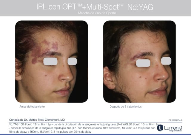 Antes y Después M22 Plataforma Láser