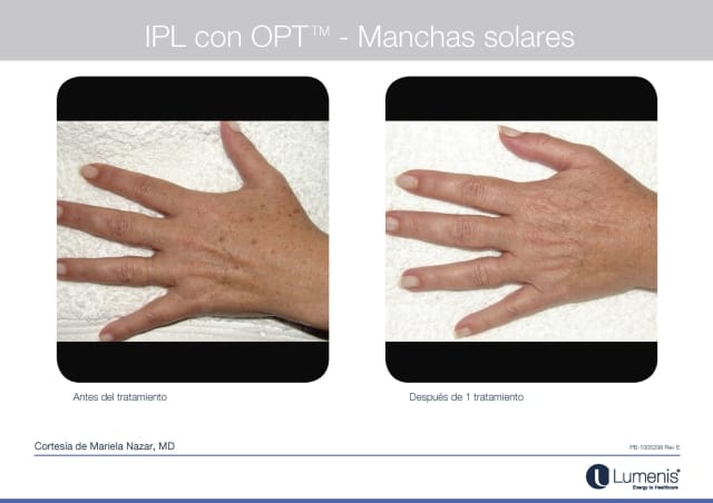 Antes y Después M22 Plataforma Láser