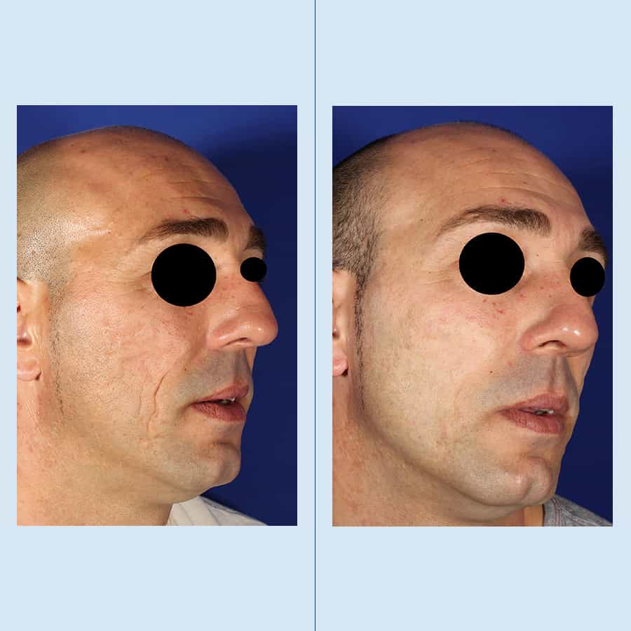 Antes y Después Acne Treatment