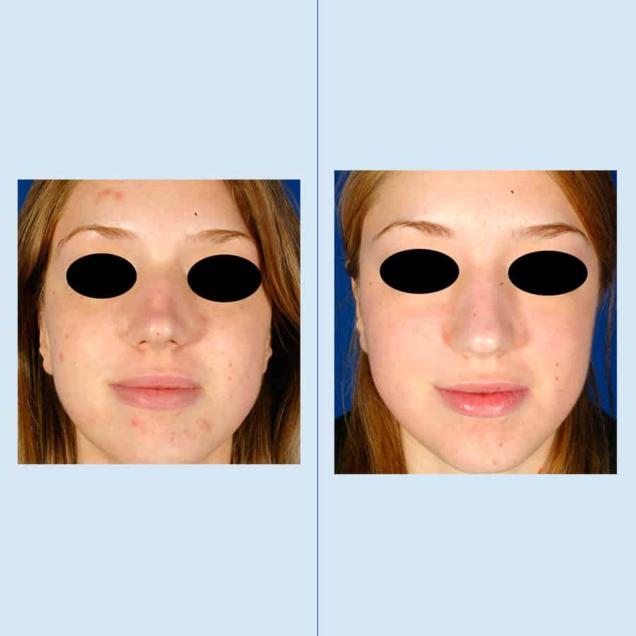 Antes y Después Tractament de l’acne