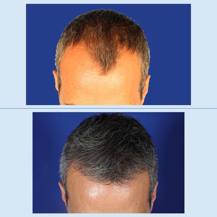 Antes y Después Hair micro-grafts