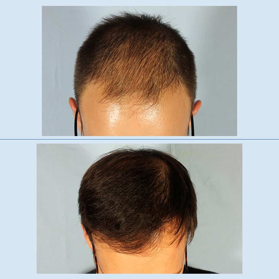 Antes y Después Microinjertos de cabello