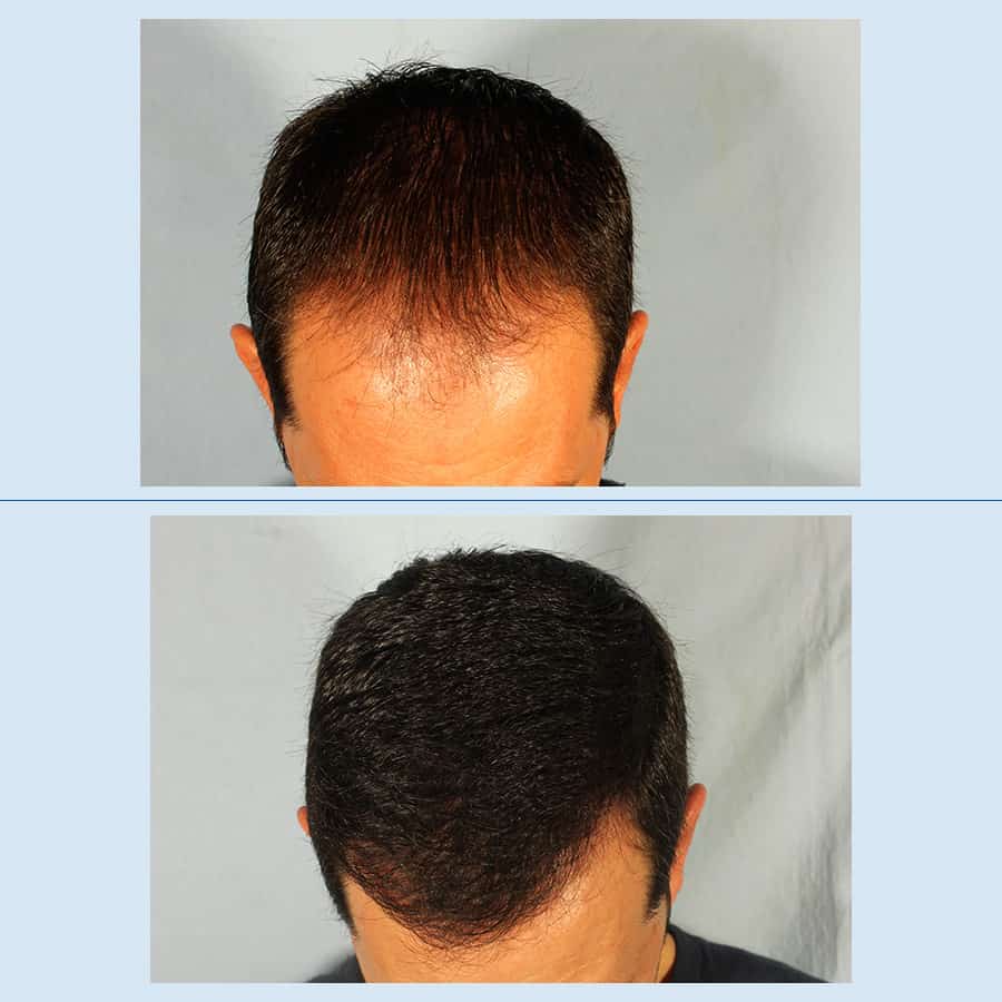 Antes y Después Microinjertos de cabello