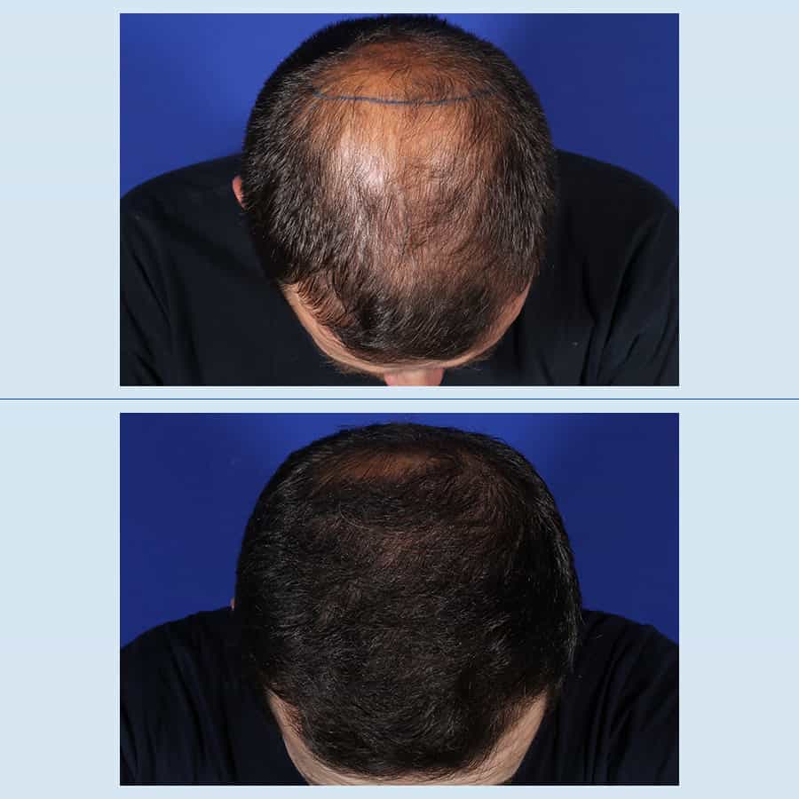 Antes y Después Hair micro-grafts