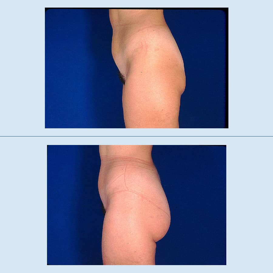 Antes y Después Gluteus Augmentation