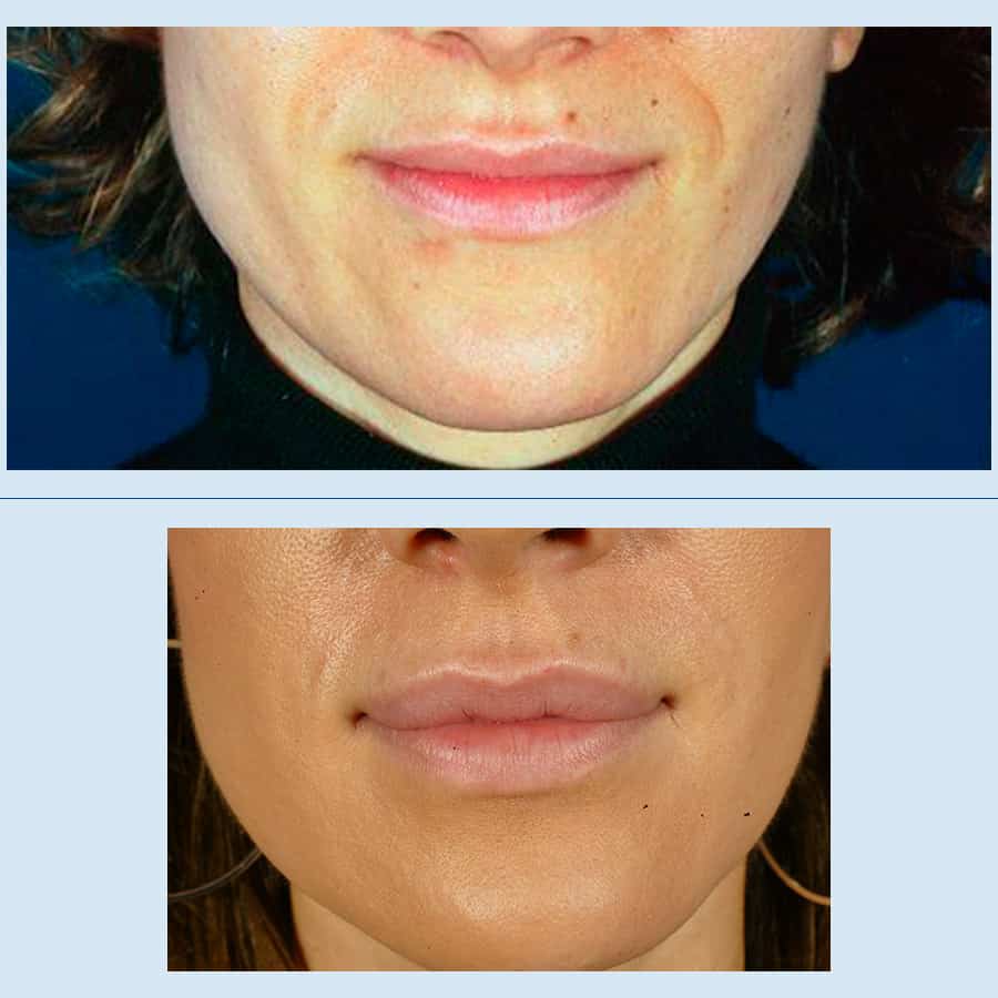 Antes y Después Lip augmentation