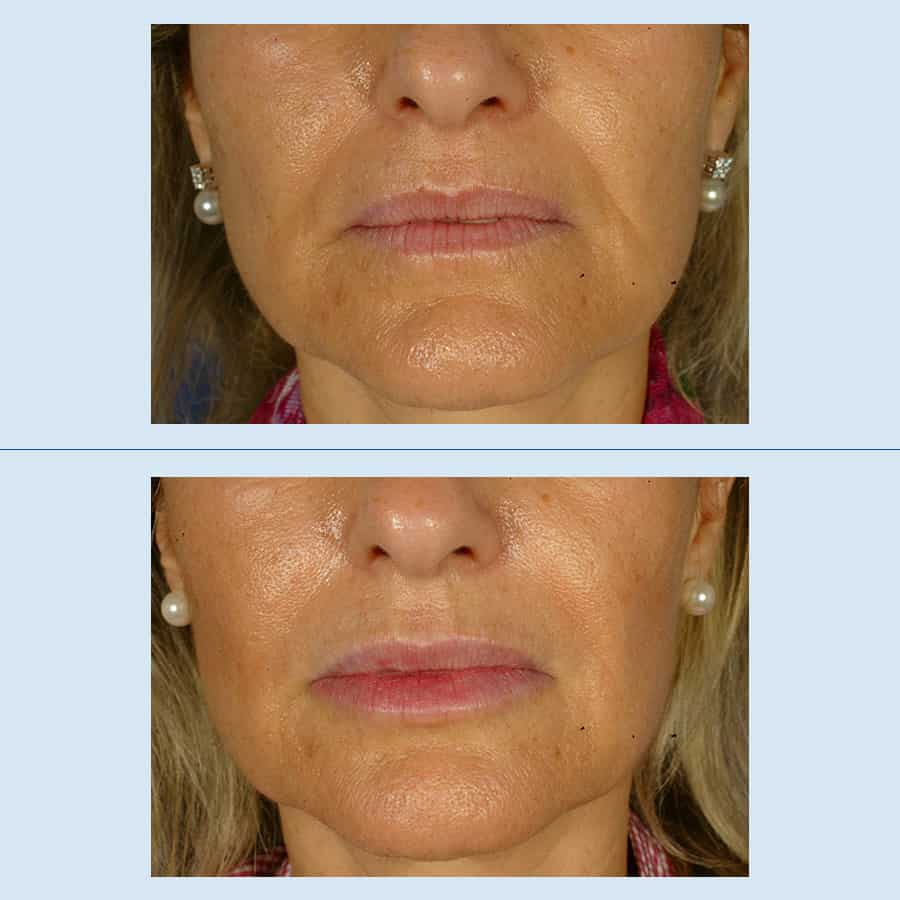 Antes y Después Lip augmentation