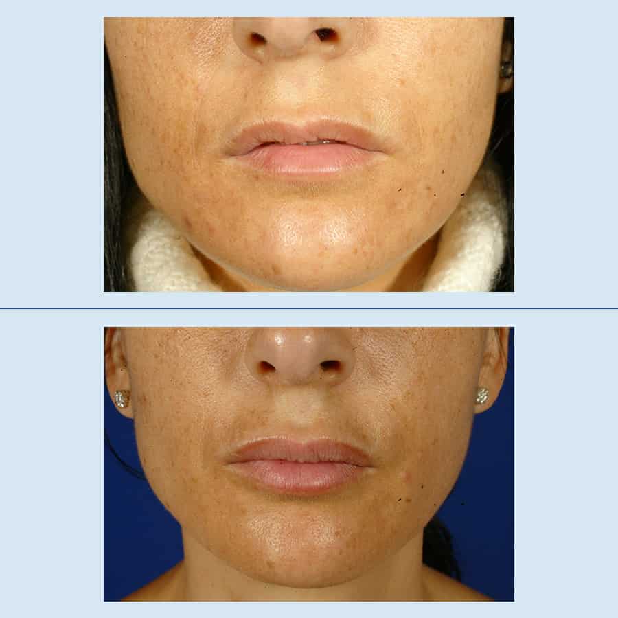Antes y Después Aumento de labios