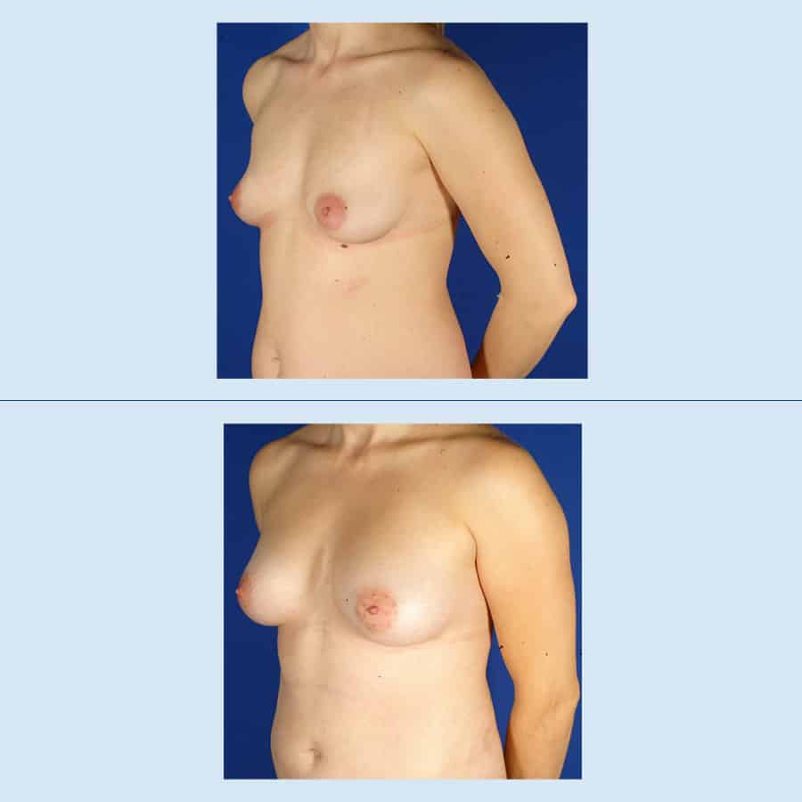 Antes y Después Breast augmentation with own fat