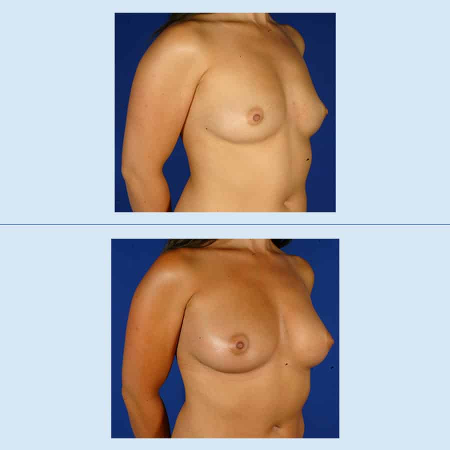 Antes y Después Breast augmentation with own fat