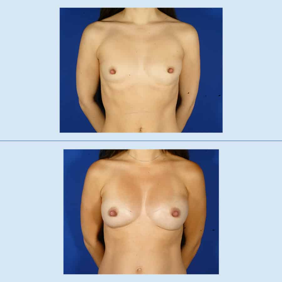 Antes y Después Breast augmentation with own fat