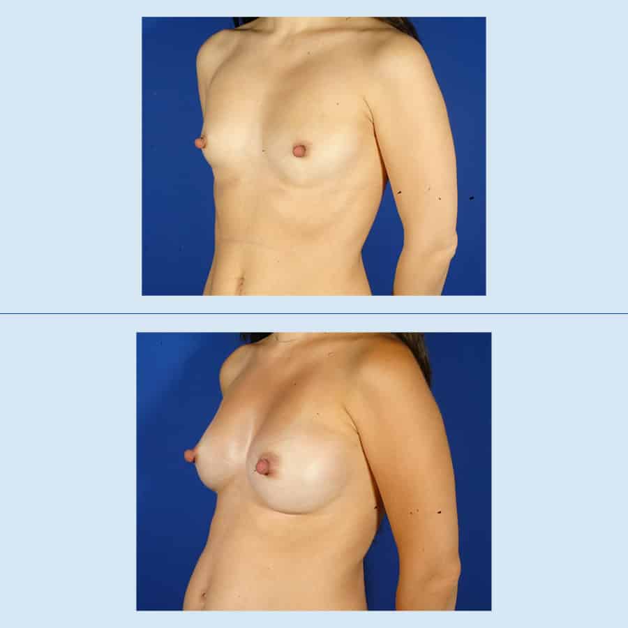 Antes y Después Breast augmentation with own fat