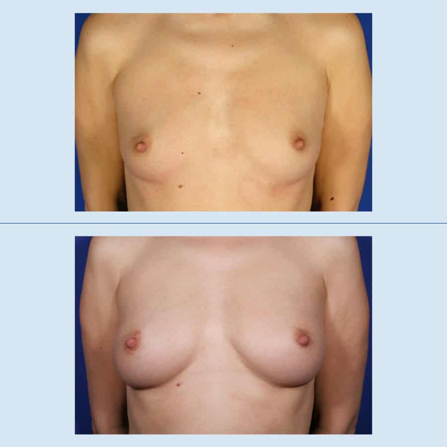 Antes y Después Breast augmentation with own fat