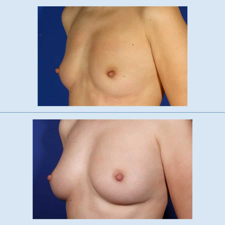 Antes y Después Breast augmentation with own fat