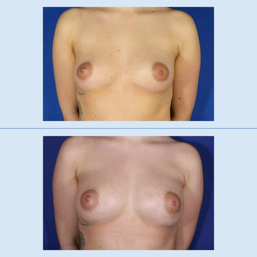 Antes y Después Breast augmentation with own fat